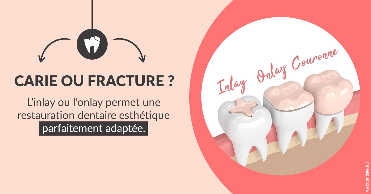https://www.dr-chavrier-orthodontie-neuville.fr/T2 2023 - Carie ou fracture 2