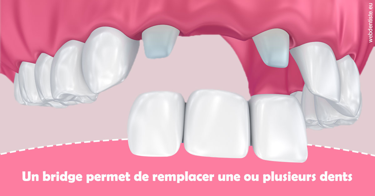 https://www.dr-chavrier-orthodontie-neuville.fr/Bridge remplacer dents 2