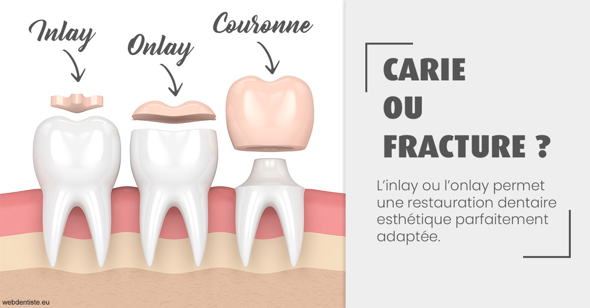 https://www.dr-chavrier-orthodontie-neuville.fr/T2 2023 - Carie ou fracture 1