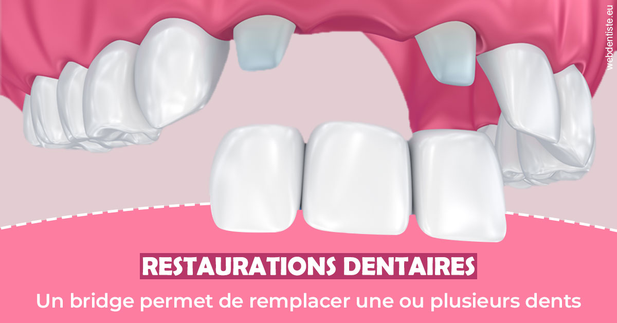 https://www.dr-chavrier-orthodontie-neuville.fr/Bridge remplacer dents 2