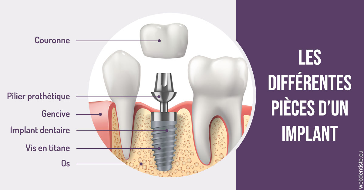https://www.dr-chavrier-orthodontie-neuville.fr/Les différentes pièces d’un implant 2