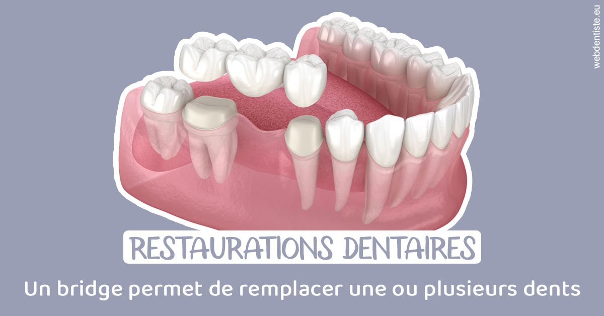 https://www.dr-chavrier-orthodontie-neuville.fr/Bridge remplacer dents 1