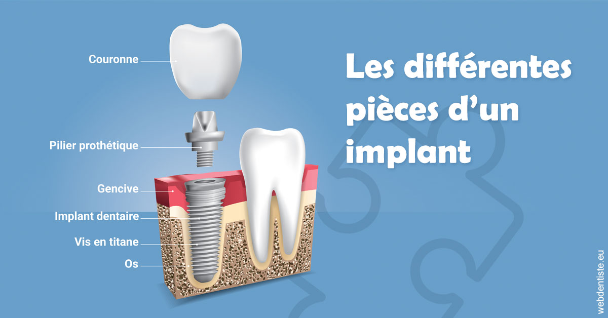 https://www.dr-chavrier-orthodontie-neuville.fr/Les différentes pièces d’un implant 1