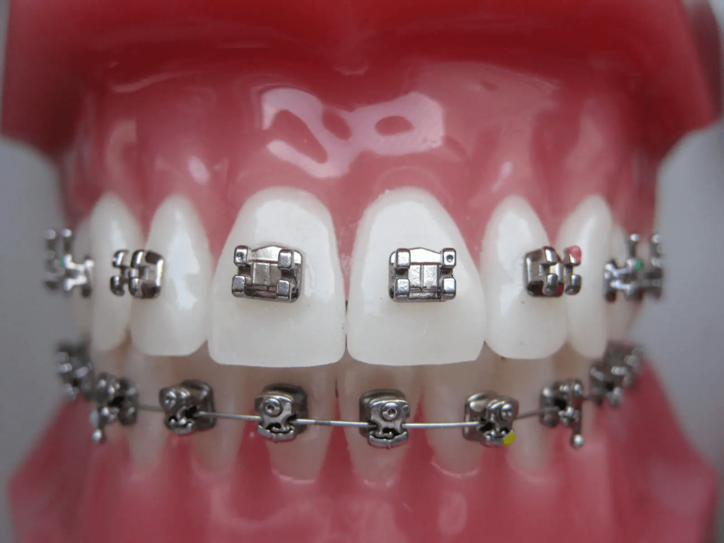 ortodontske-bravice-001